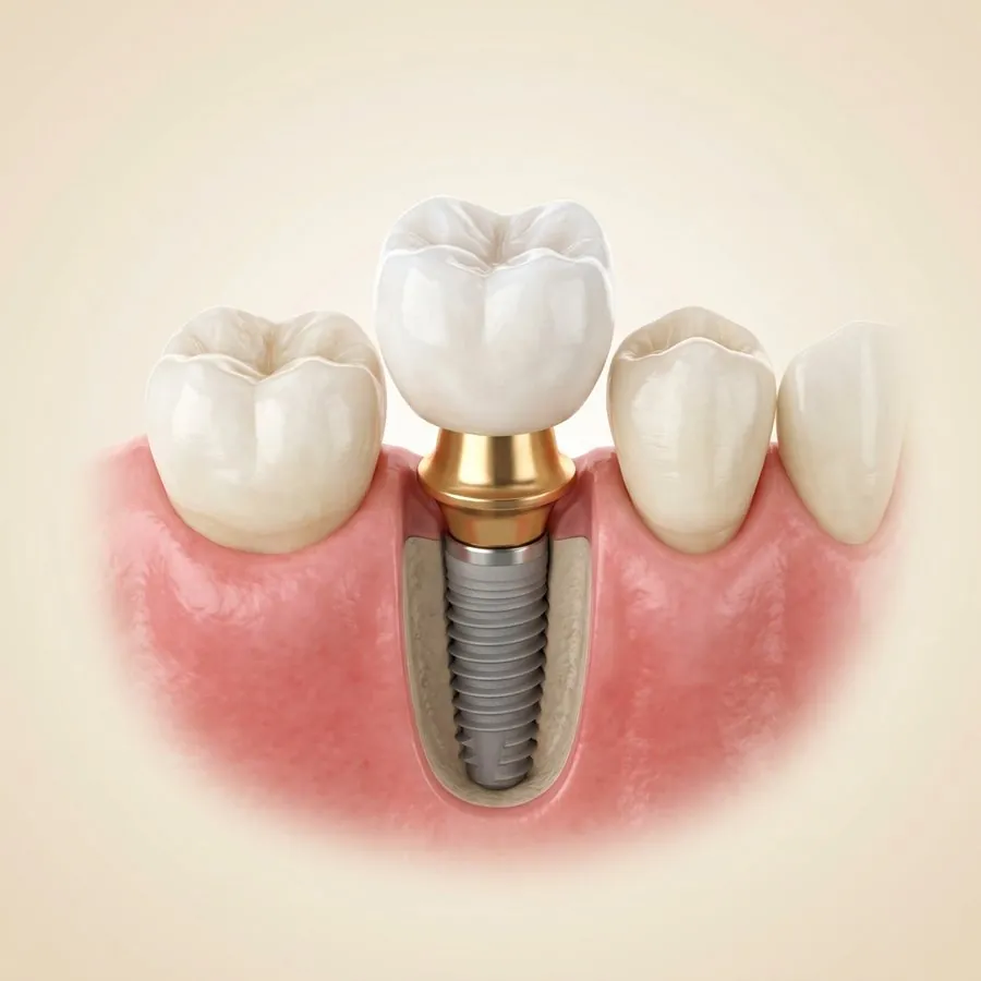Implants dentaires